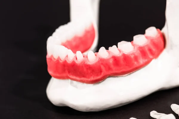 Zuby Implantát Koruny Instalace Části Izolované Černém Pozadí Lékařsky Přesný — Stock fotografie