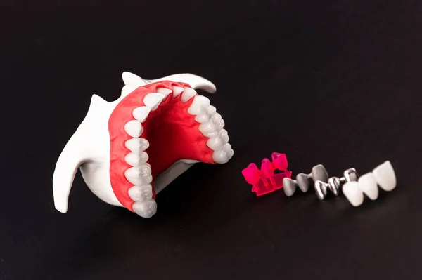 Denti Impianto Corona Parti Processo Installazione Isolate Uno Sfondo Nero — Foto Stock