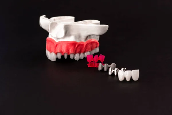 Детали Процесса Установки Имплантатов Коронки Зубов Изолированы Черном Фоне Медицинская — стоковое фото