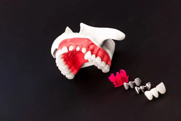 Zahnimplantat Und Kroneneinbau Verarbeiten Teile Isoliert Auf Schwarzem Hintergrund Medizinisch — Stockfoto