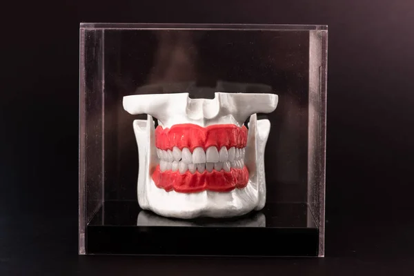 Человеческая Челюсть Имплантатами Зубов Анатомическая Модель Изолирована Черном Фоне Стеклянной — стоковое фото