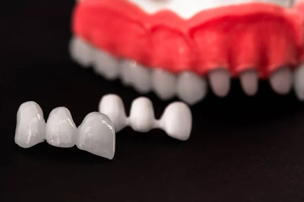 Tanden Implantaat Kroon Installatie Proces Onderdelen Geïsoleerd Een Zwarte Achtergrond — Stockfoto