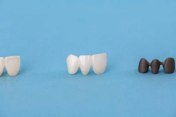 Diş Implantı Taç Yerleştirme Işlemi Parçaları Mavi Arka Planda Izole — Stok fotoğraf