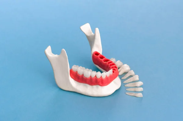 假牙植入物和冠的安装过程部分隔离在蓝色的背景上 医学上准确的3D模型 Hi质量3D复制Space模型 — 图库照片
