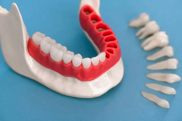 Teeth Implant Crown Installation Process Parts Isolated Blue Background Medically — Stock Photo, Image