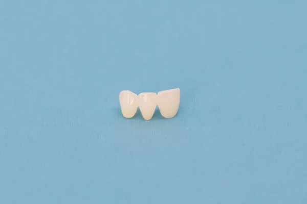 Dents Céramique Sans Métal Implant Couronnes Dentaires Isolées Sur Fond — Photo