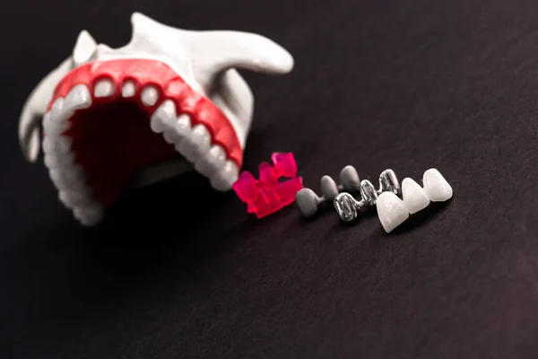 Teeth Implant Crown Installation Process Parts Isolated Black Background Medically — Stock Photo, Image