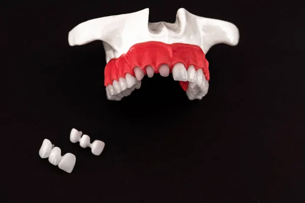 Dentes Implante Coroa Peças Processo Instalação Isolado Fundo Preto Modelo — Fotografia de Stock