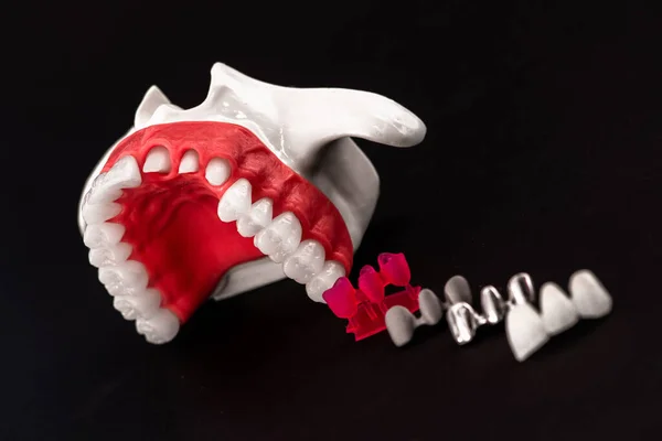 Teeth Implant Crown Installation Process Parts Isolated Black Background Medically — Stock Photo, Image