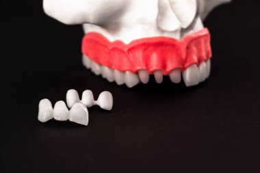 Diş implantı ve taç yerleştirme işleminin parçaları siyah arka planda izole edilmiş. Tıbben doğru 3D model. Merhaba kaliteli fotokopi alanı fotoğrafı. 