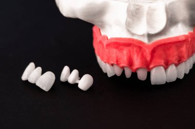 Diş implantı ve taç yerleştirme işleminin parçaları siyah arka planda izole edilmiş. Tıbben doğru 3D model. Merhaba kaliteli fotokopi alanı fotoğrafı. 