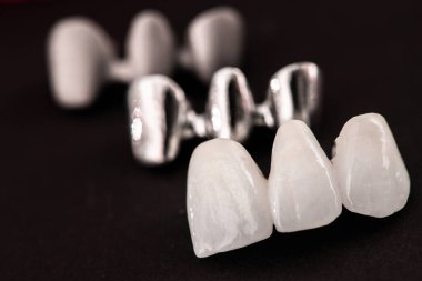 Diş implantı ve taç yerleştirme işleminin parçaları siyah arka planda izole edilmiş. Tıbben doğru 3D model. Merhaba kaliteli fotokopi alanı fotoğrafı. 
