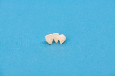 Metalsiz seramik dişler mavi arka planda izole edilmiş diş implantları yerleştirir. Merhaba kaliteli fotokopi alanı fotoğrafı.