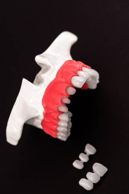 Diş implantı ve taç yerleştirme işleminin parçaları siyah arka planda izole edilmiş. Tıbben doğru 3D model. Merhaba kaliteli fotokopi alanı fotoğrafı. 