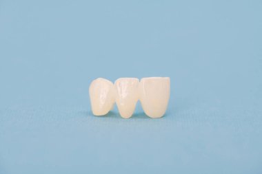 Metalsiz seramik dişler mavi arka planda izole edilmiş diş implantları yerleştirir. Merhaba kaliteli fotokopi alanı fotoğrafı.