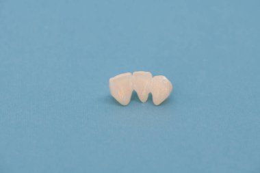 Metalsiz seramik dişler mavi arka planda izole edilmiş diş implantları yerleştirir. Merhaba kaliteli fotokopi alanı fotoğrafı.
