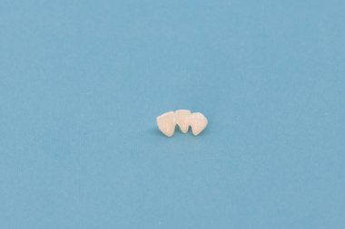 Metalsiz seramik dişler mavi arka planda izole edilmiş diş implantları yerleştirir. Merhaba kaliteli fotokopi alanı fotoğrafı.