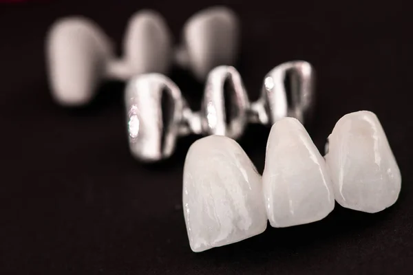 Tänder Implantat Och Krona Installationsprocessen Delar Isolerade Svart Bakgrund Medicinskt — Stockfoto