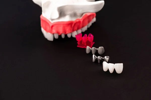 Części Procesu Implantacji Zębów Korony Izolowane Czarnym Tle Medycznie Dokładny — Zdjęcie stockowe
