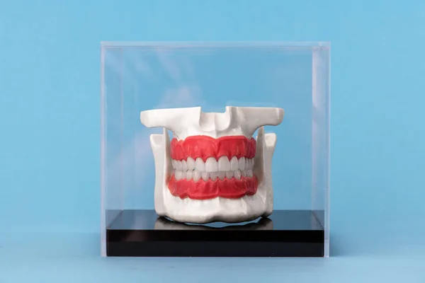 Menschlicher Kiefer Mit Zahnimplantaten Anatomie Modell Isoliert Auf Blauem Hintergrund — Stockfoto