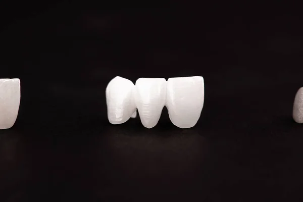 Dentes Implante Coroa Peças Processo Instalação Isolado Fundo Preto Modelo — Fotografia de Stock