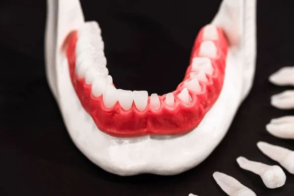 Tänder Implantat Och Krona Installationsprocessen Delar Isolerade Svart Bakgrund Medicinskt — Stockfoto