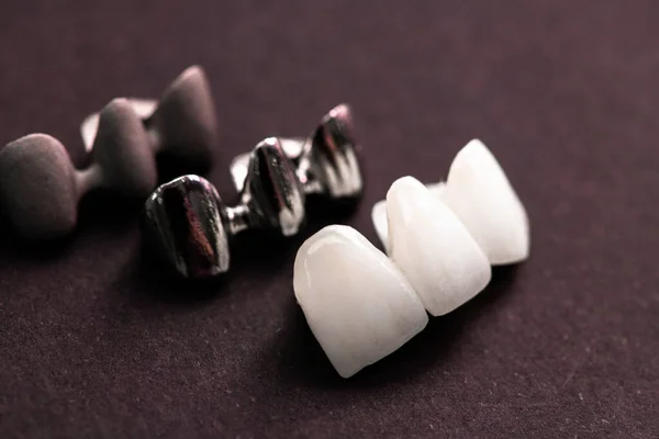 Teeth Implant Crown Installation Process Parts Isolated Black Background Medically — Stock Photo, Image