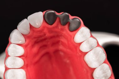 Diş implantı ve taç yerleştirme işleminin parçaları mavi arka planda izole edilir. Tıbben doğru 3D model. Merhaba kaliteli fotokopi alanı fotoğrafı. 