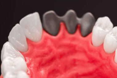 Diş implantı ve taç yerleştirme işleminin parçaları mavi arka planda izole edilir. Tıbben doğru 3D model. Merhaba kaliteli fotokopi alanı fotoğrafı. 