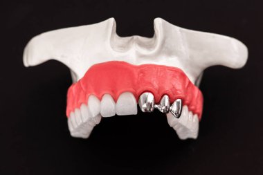 Diş implantı ve taç yerleştirme işleminin parçaları mavi arka planda izole edilir. Tıbben doğru 3D model. Merhaba kaliteli fotokopi alanı fotoğrafı. 