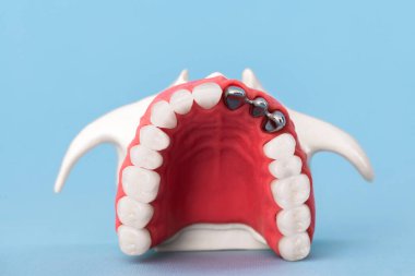 Diş implantı ve taç yerleştirme işleminin parçaları mavi arka planda izole edilir. Tıbben doğru 3D model. Merhaba kaliteli fotokopi alanı fotoğrafı. 