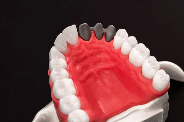 Las Piezas Del Proceso Instalación Del Implante Dental Corona Están —  Fotos de Stock