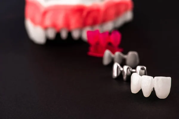 Diş Implantı Taç Yerleştirme Işleminin Parçaları Mavi Arka Planda Izole — Stok fotoğraf