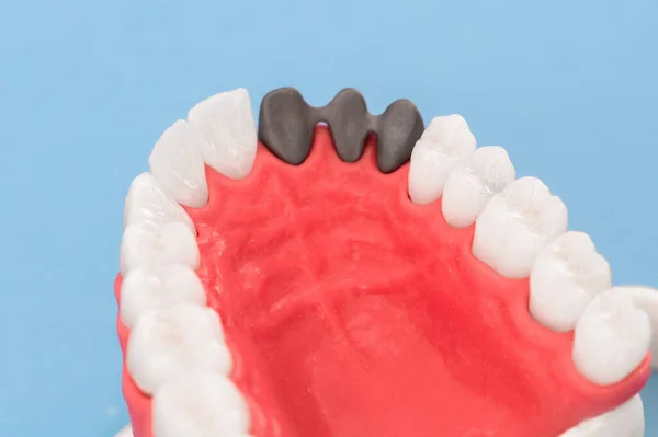Proces Instalace Zubního Implantátu Koruny Jsou Izolovány Modrém Pozadí Lékařsky — Stock fotografie