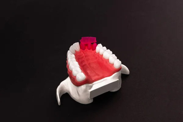 Peças Processo Instalação Implante Coroa Dos Dentes São Isoladas Fundo — Fotografia de Stock