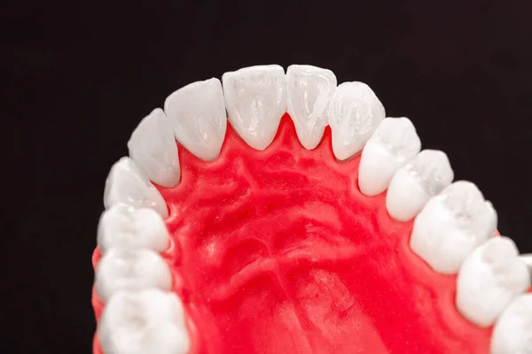 Tanden Implantaat Kroon Installatie Proces Onderdelen Zijn Geïsoleerd Een Blauwe — Stockfoto