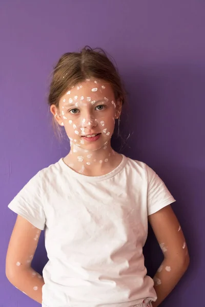 一个带有水痘的小女孩的画像 涂在脸上和身体上的防腐霜 紫色或紫色背景 高质量的照片 — 图库照片