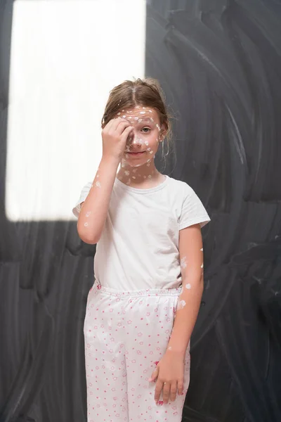 Portret Van Een Schoolmeisje Met Waterpokken Ontsmettende Crème Aangebracht Gezicht — Stockfoto