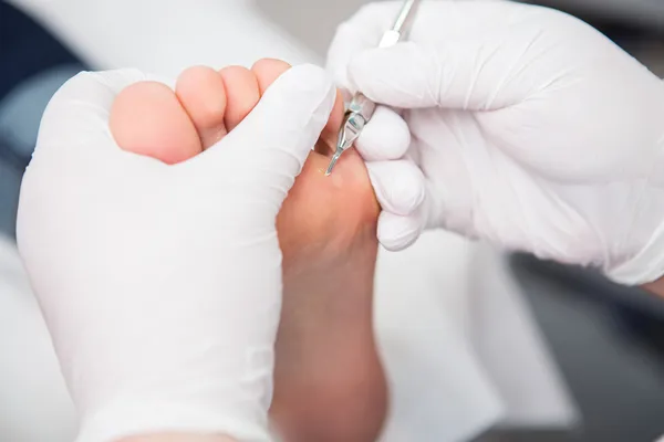 Podiatrist ( chiropodist ) cleaning womans feet ( toenails ) — Stock Photo, Image