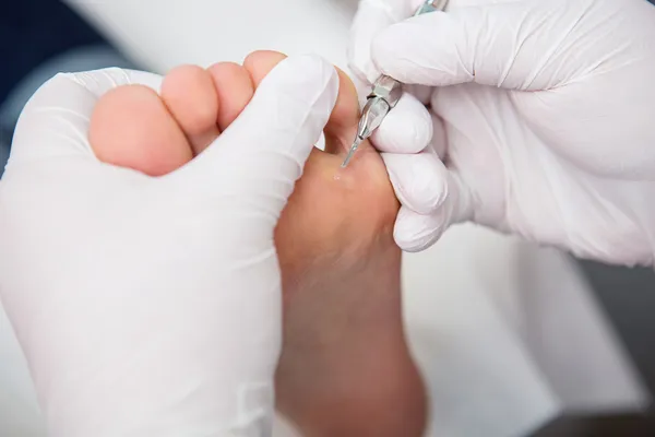 Podiatrist ( chiropodist ) cleaning womans feet ( toenails ) — Stock Photo, Image