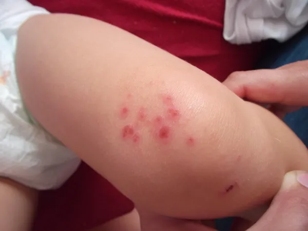 一个小孩的腿上过敏性皮疹 图库图片