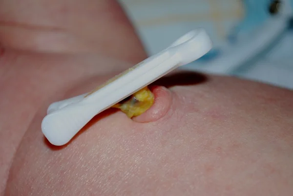 Umbigo recém-nascido - corte do cordão umbilical — Fotografia de Stock