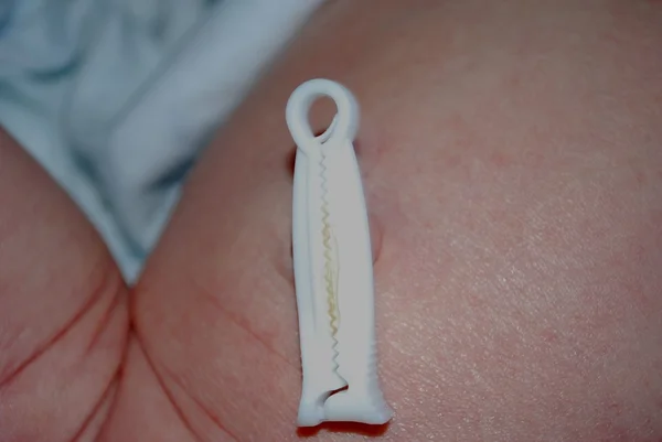 新生児おへそ - 臍帯カット — ストック写真