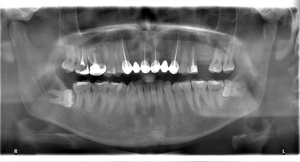 insan kafatası ve diş panaromik diş röntgeni
