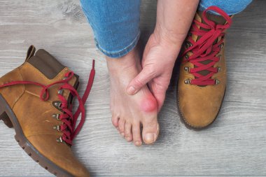 Kadın ayakkabılarını sorunlu bir bacaktan çıkarıyor. İltihaplı acı. Kemik problemi ayakları (Hallux valgus)