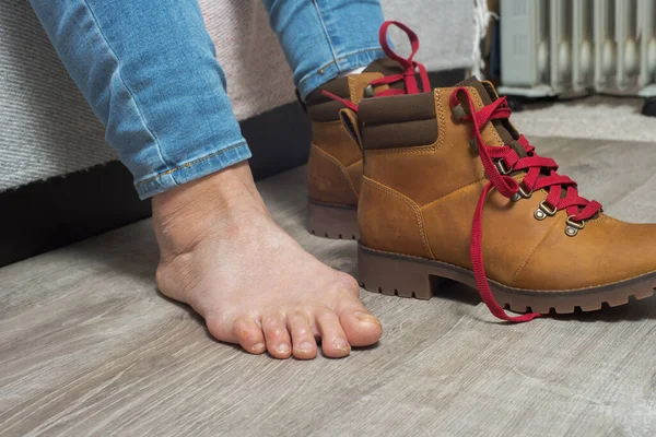 Mulher Tira Sapatos Uma Perna Dorida Problemática Problema Ósseo Pés — Fotografia de Stock