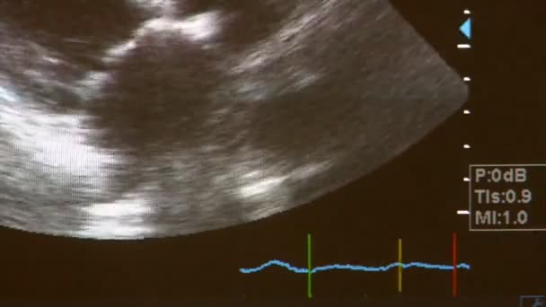 Ultra-sonografia do coração humano — Vídeo de Stock