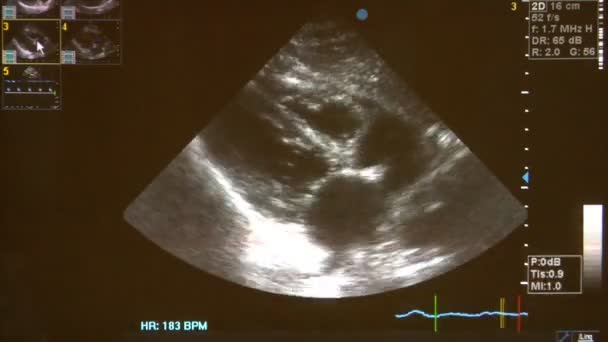 Ultra-sonografia do coração humano — Vídeo de Stock