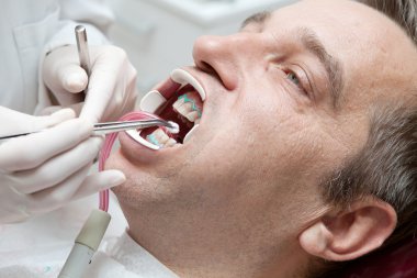 diş beyazlatma işlemi dişçi ofisinde sırasında adam