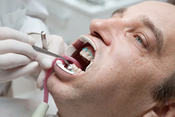 男性患者の歯科治療に歯科医と — ストック写真